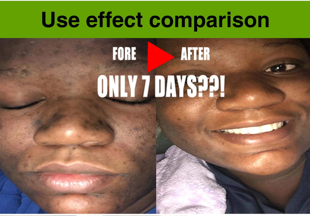 AILKE Aloe Vera Whitening Soap, Remove Acne, Pimples, Skin Radiant, Improve Skin Luster, Vegan Bath Wash for All Skin Types